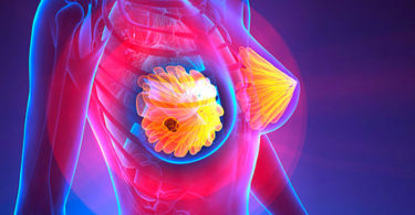 ¿Qué enfrenta una mujer con diagnóstico de cáncer de mama?