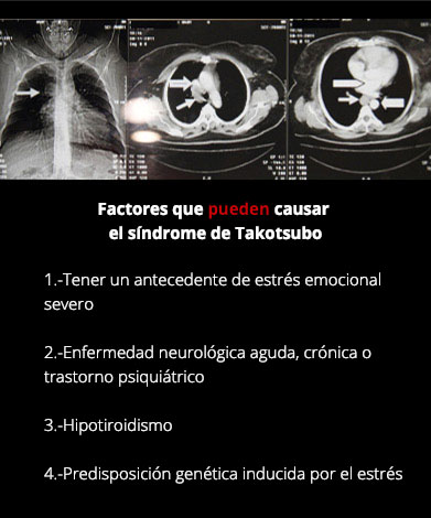 Síndrome de Takotsubo, ¿es posible morir de amor?