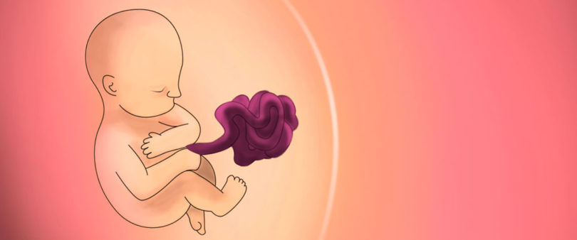 Gastrosquisis, el defecto congénito que desafía a la perinatología en México