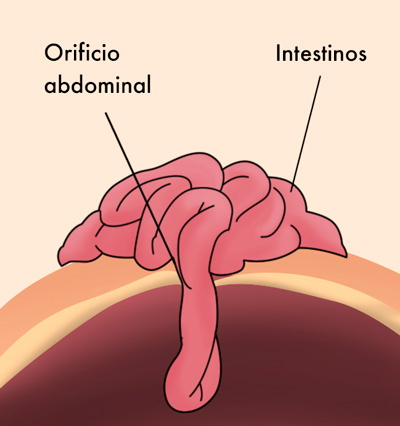 Gastrosquisis, el defecto congénito que desafía a la perinatología en México