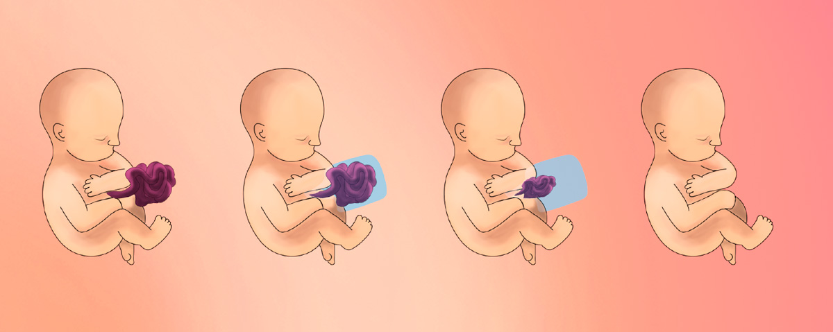 Gastrosquisis, el defecto congénito que desafía a la perinatología en México