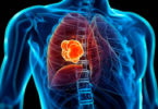 Crea IPN herramienta computacional para detectar cáncer de pulmón