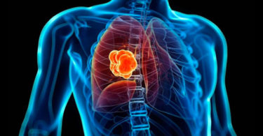 Crea IPN herramienta computacional para detectar cáncer de pulmón