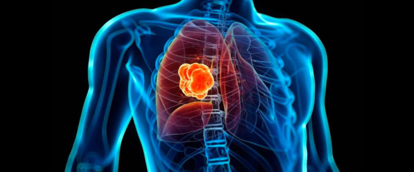 Crea IPN herramienta computacional para detectar cáncer de pulmón