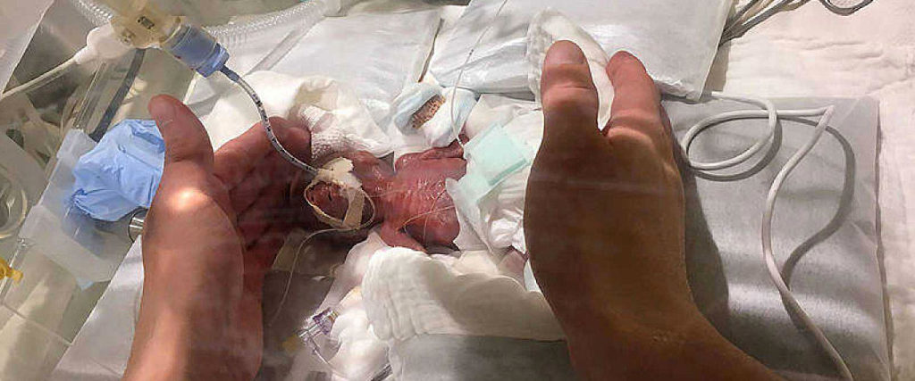 Sobrevive prematuro de 24 semanas y rompe récord