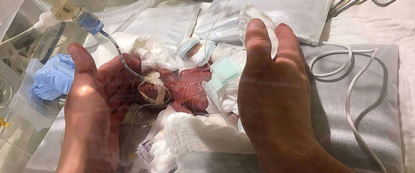Sobrevive prematuro de 24 semanas y rompe récord