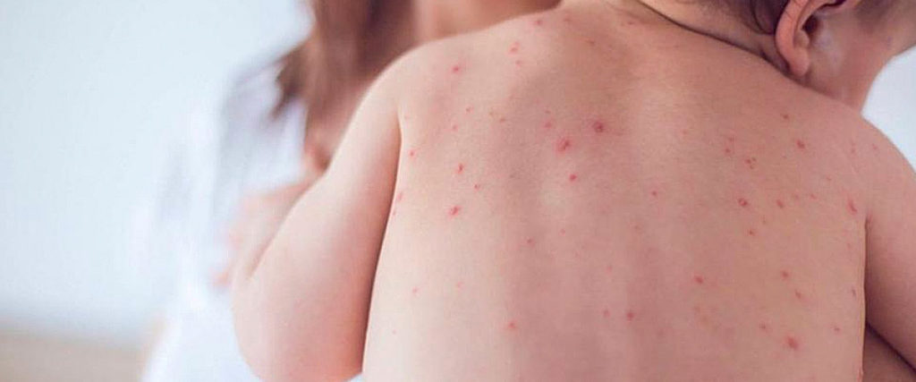 Alarmante, aumento de casos de sarampión: Unicef