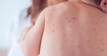 Alarmante, aumento de casos de sarampión: Unicef
