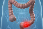 Descubren que árnica tiene efecto tóxico contra cáncer de colon