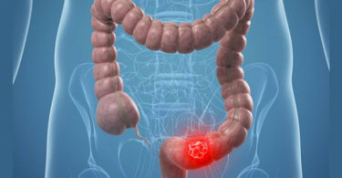 Descubren que árnica tiene efecto tóxico contra cáncer de colon