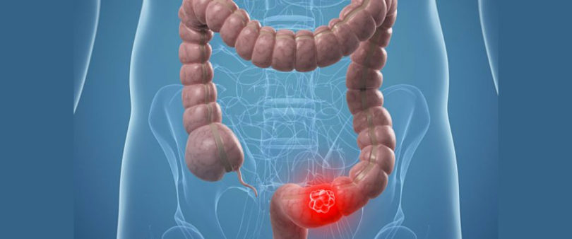 Descubren que árnica tiene efecto tóxico contra cáncer de colon