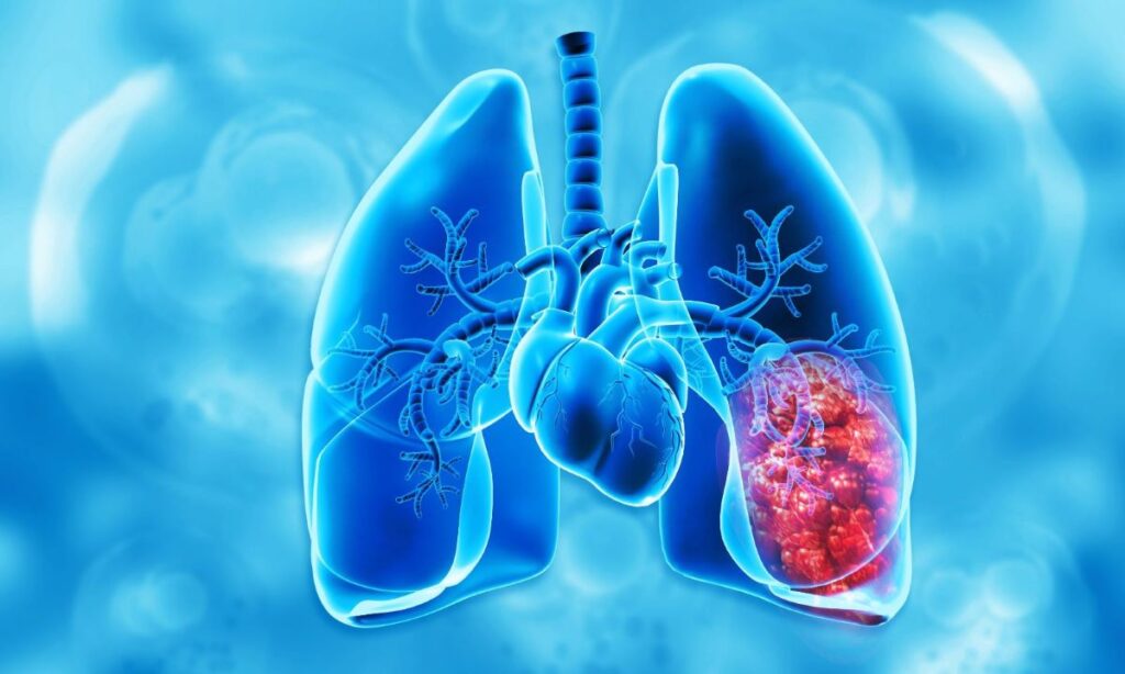 Cáncer de pulmón CPCNP