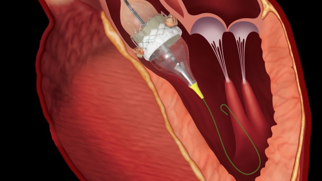 Colocación de válvula cardiaca transcatéter