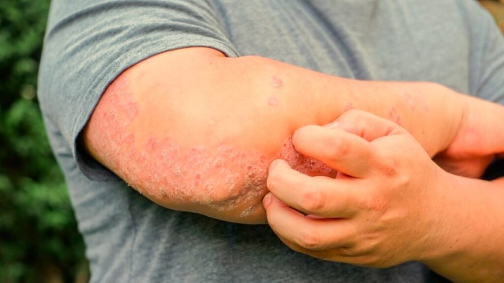 FOTO 1 Campaña Mi Psoriasis