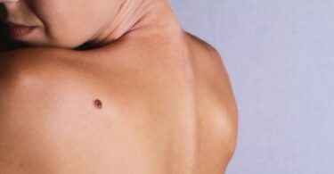Melanoma_Bristol-Myers-Squibb
