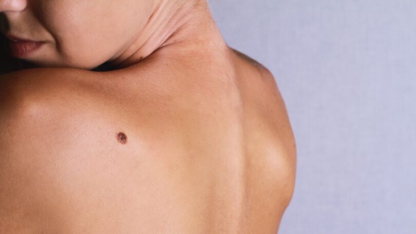 Melanoma_Bristol-Myers-Squibb