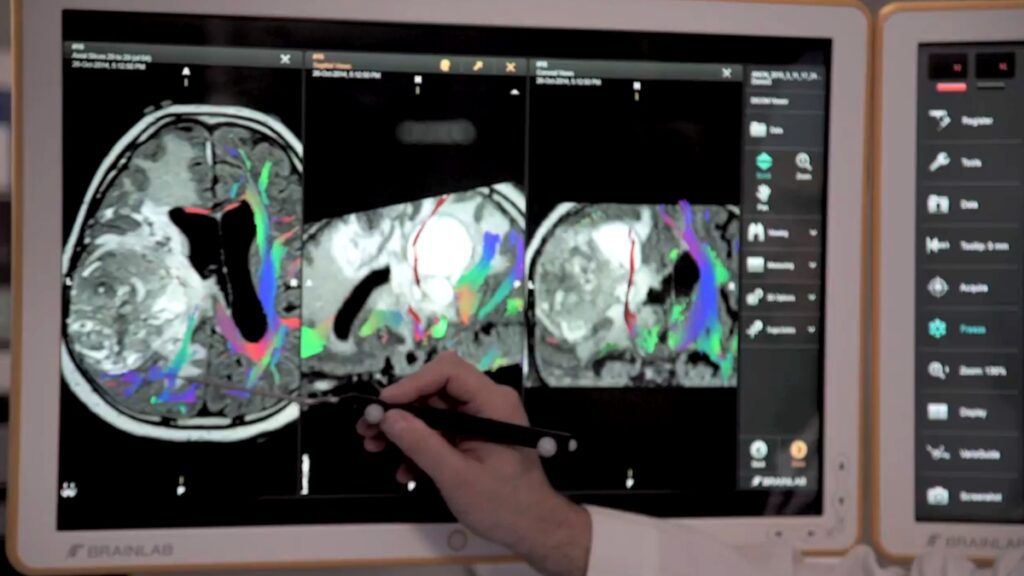 Tumor cerebral_Houston Methodist Hospital