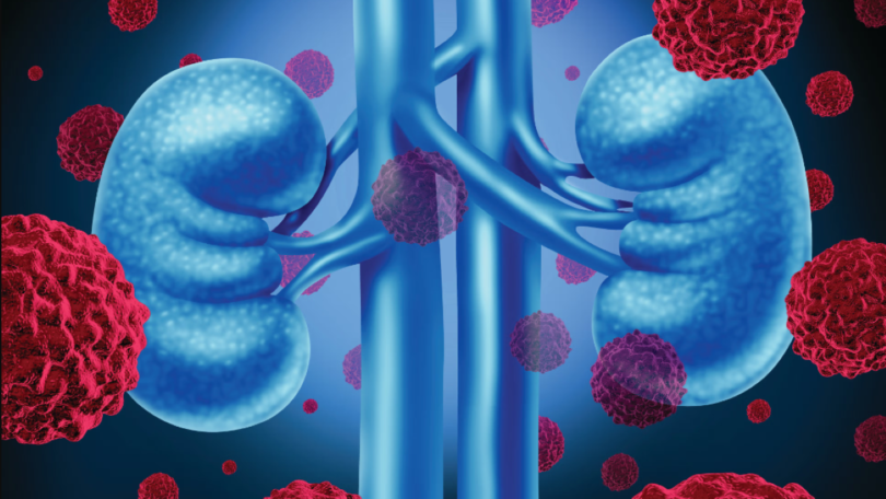 Cancer-de-riñon_Fotolia