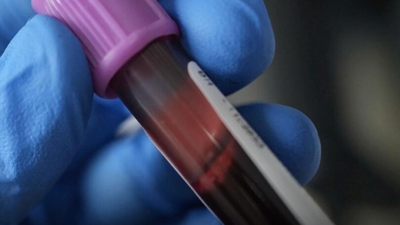 Terapia-vs-quemaduras_IMSS-Bienestar