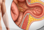 260629 (1) Hernia_Medtronic